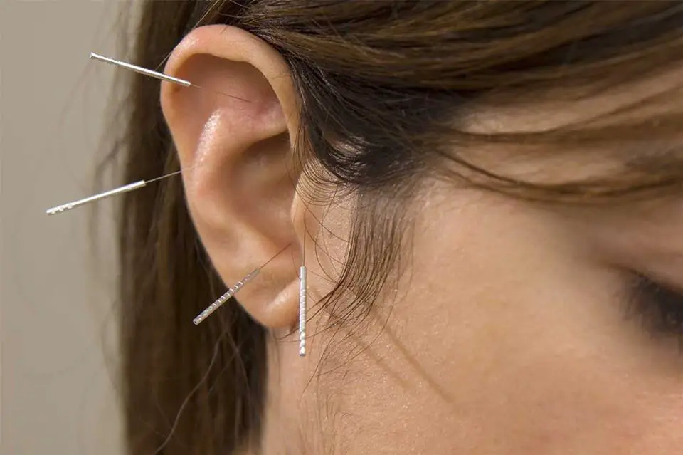 Acupuntura en orejas es una de las técnicas más efectivas para bajar de peso