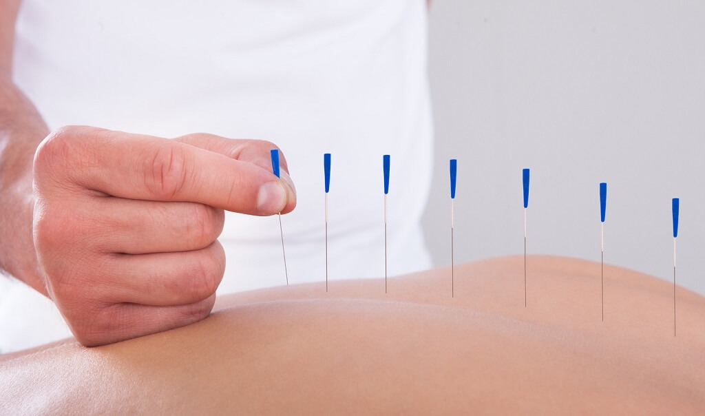 Acupuntura: Beneficios y Críticas de esta práctica - Relajemos.com